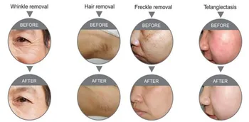 Alma Super Soprano Hair Removal / Alma Soprano Hair Removal Machine / Alma Soprano Diode Laser 2017