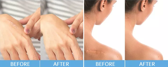 scar gel for removing scars