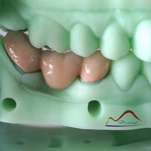 3D Printing Model PFM COCR Bridge