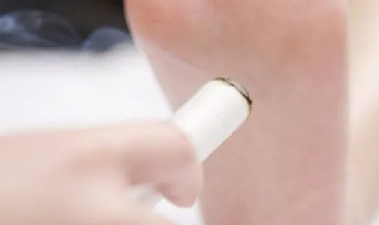 Chinese Moxibustion Therapy