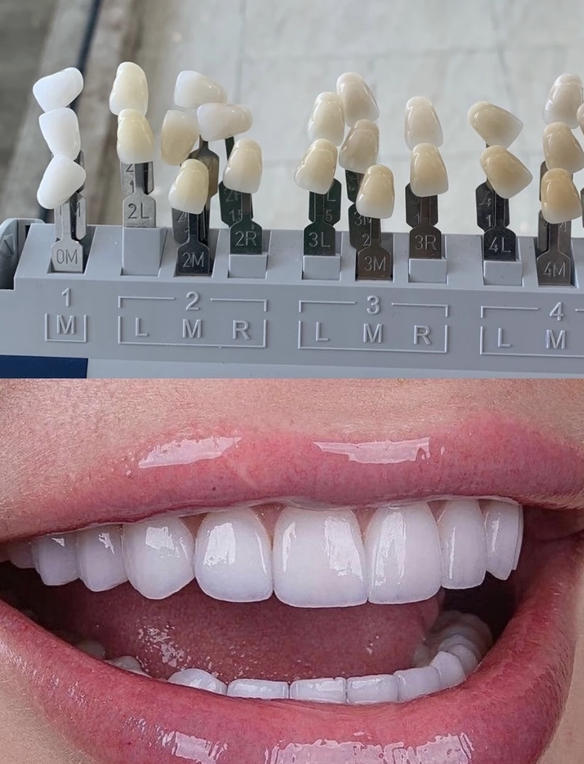 impiallacciatura veneer