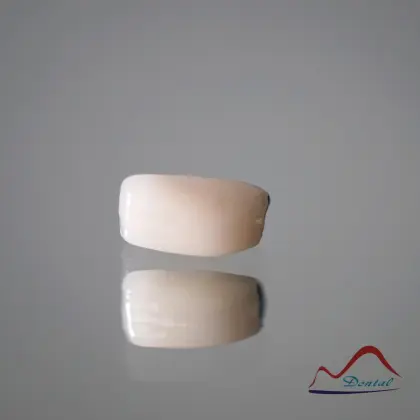 Mandibular Dental Implant Crown