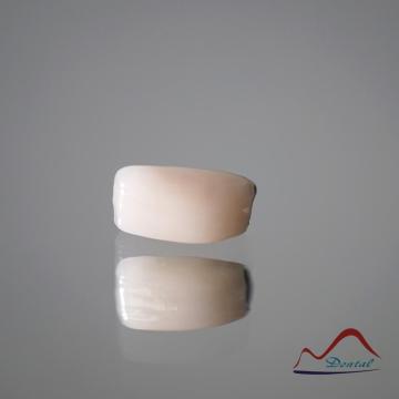 Mandibular Dental Implant Crown