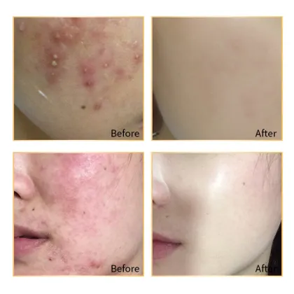 Gentle Facial Anti Acne Treatment Acne Cream