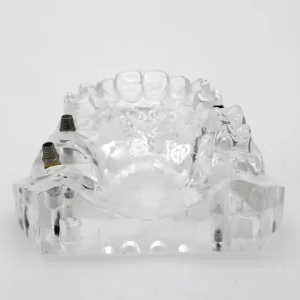 Dental Implant Model Overdenture Restoration Dental Teeth Model Factory Shop On Sale High Quality