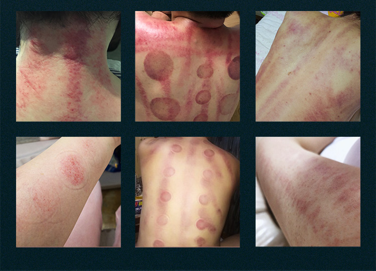 fat cavitation machine