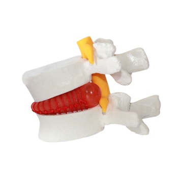 PVC Spine Model for Lumbar Disc Herniation Education