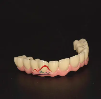 Malo Implant Bridge Restoration