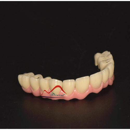 Malo Implant Bridge Restoration