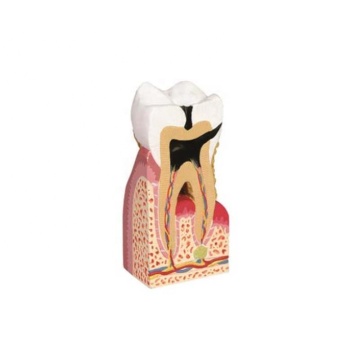 Darhmmy Medical Science 10x pathologisch molair tanden tandheelkundig model
