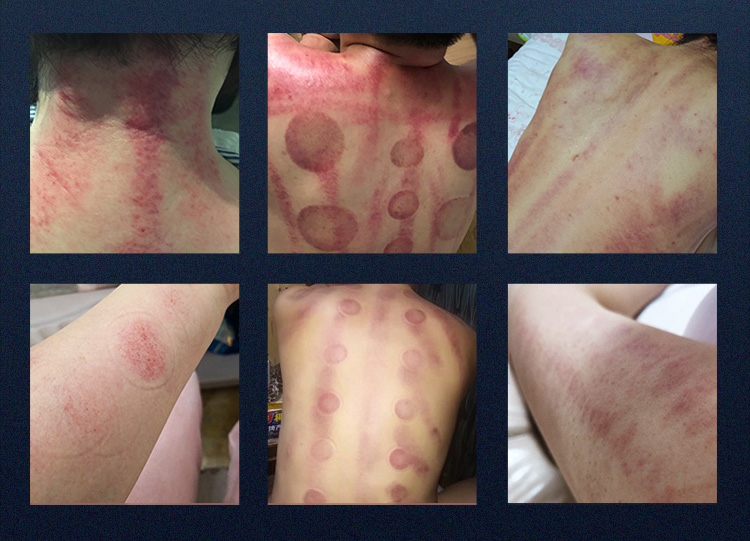 ultrasonic cavitation fat reduction system