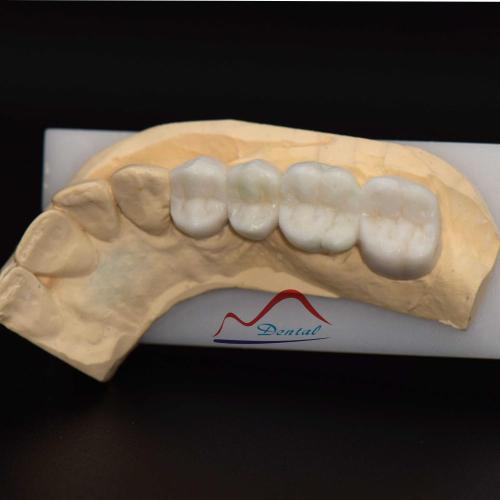 Posterior Aestherics Diagnostic Wax Up