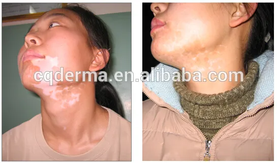 Eczema therapy lamp home use for whole body