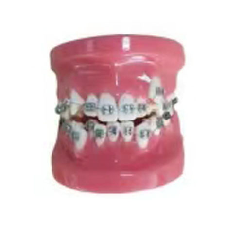 Modelo de ortodoncia fijo (modelo dental)