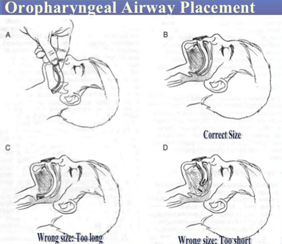 Oropharyngeal Airway