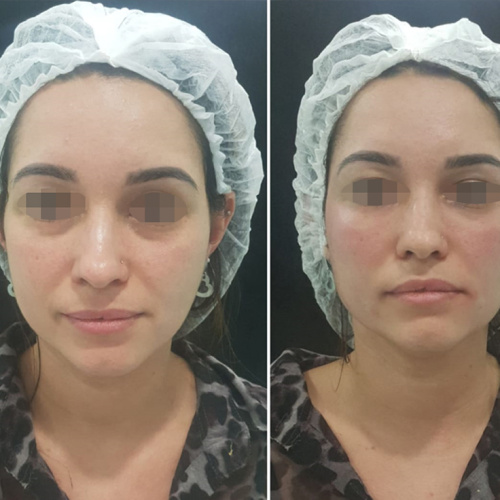 Hidratante Renacimiento de 500 mg PLLA Filler