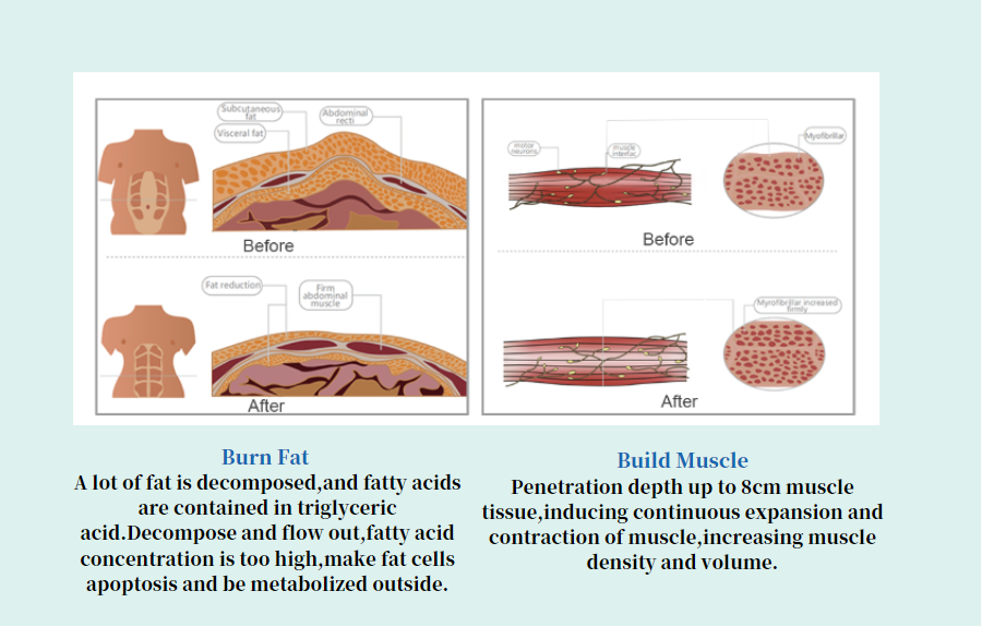 Principle of EMS Sculpting 