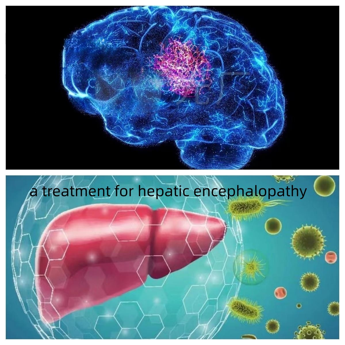 A Treatment For Hepatic Encephalopathy