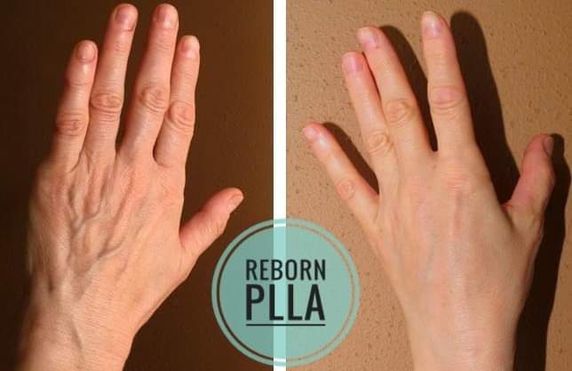 Hands Rejuvenation Treatment