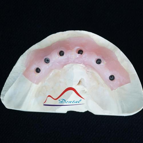 Implant Wax Rim Try In