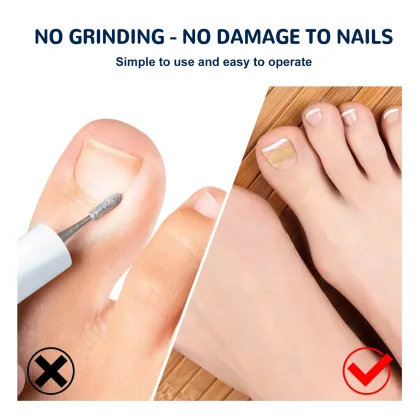 Glue-Free Ingrown Toenail Correction Sticker Patch - Foot Care Treatment