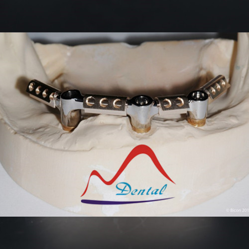 Implant Dolder Bar OverDenture