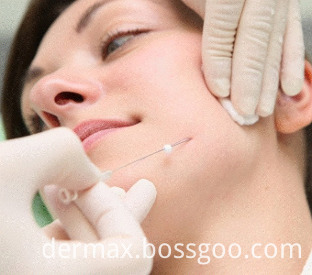 thread-lift for face