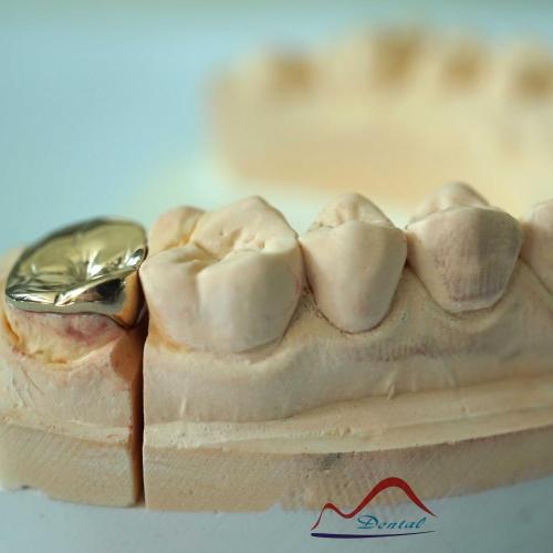 DENTAL Molar Gold Onlay