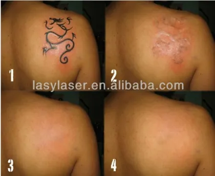 Laser Makeup Eyebrow Removal Beauty Machine