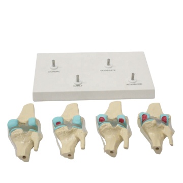 4 giai đoạn thoái hóa đầu gối kích thước sống Mô hình giải phẫu cho giảng dạy giải phẫu
