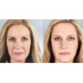 profhilo filler facial under eyes neck jowls injection