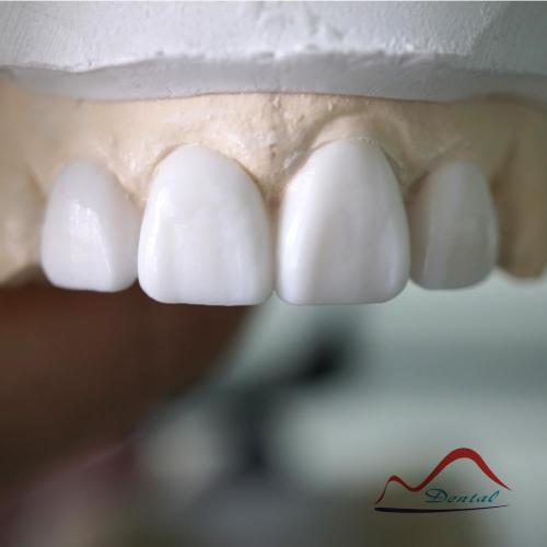 Aesthetic Dental Diagnostic Wax-up