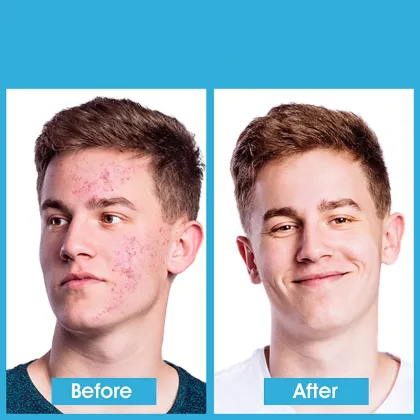 OEM herbal anti-acne cream