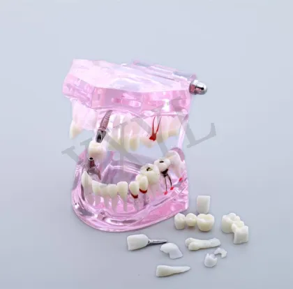 Pathological Dental Implant Restoration Model for Demonstration