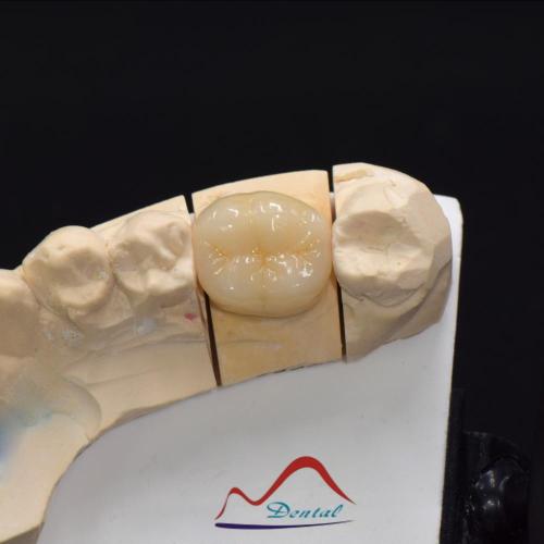 Posterior IPS e.max Press Prosthesis