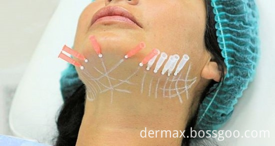 magik thread treatment