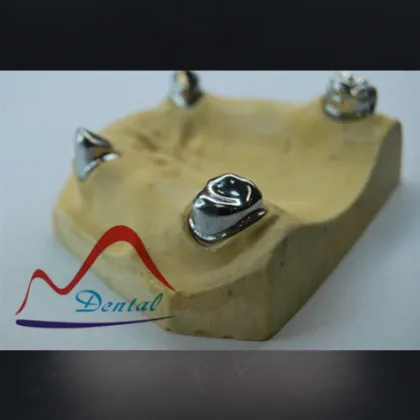 Dental Nice Looking Telescopic Crown