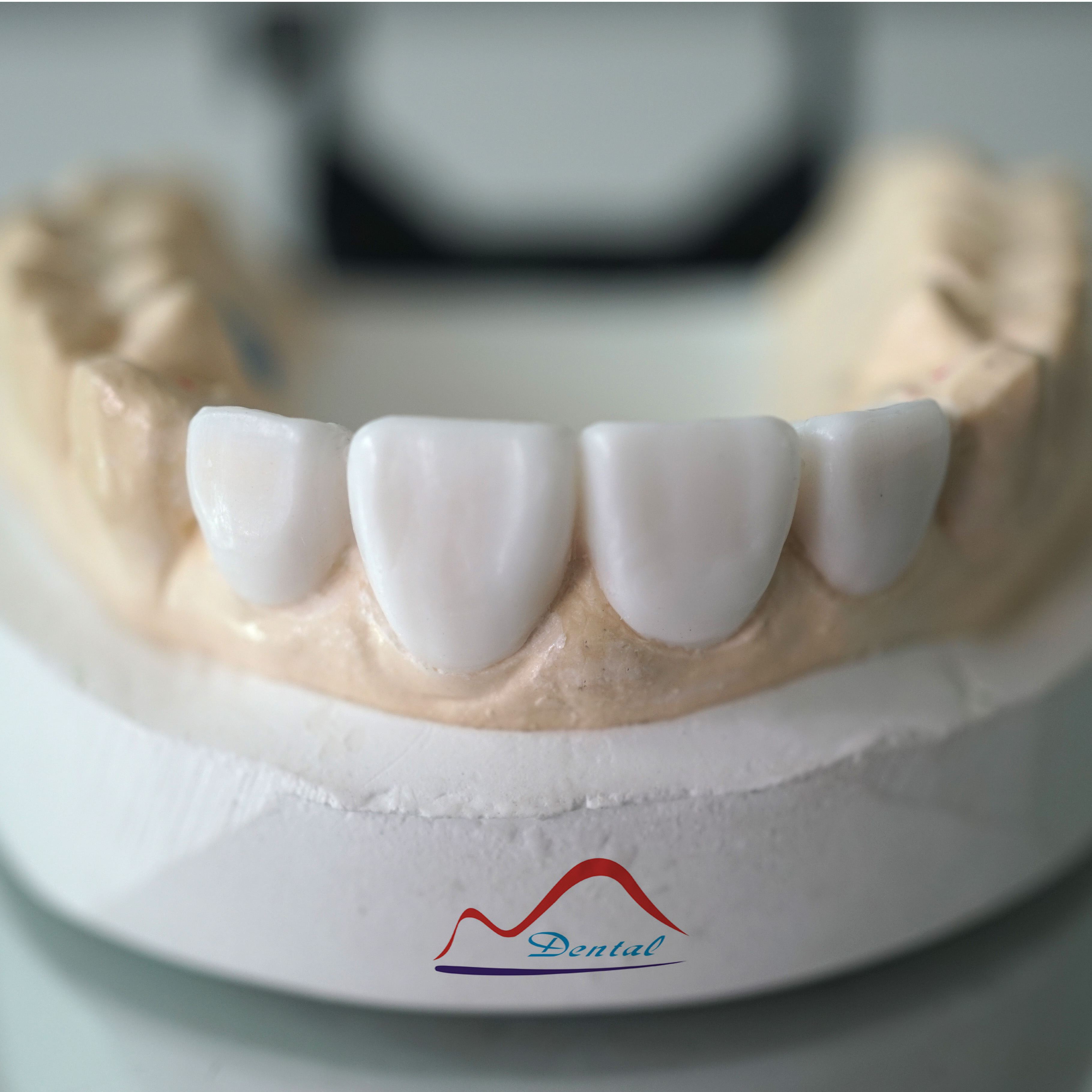 Diagnostic Wax-up