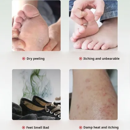Hunmui Herbal Foot Care Solution: Anti-Itching Whitening Spray for Foot Sweat and Dryness