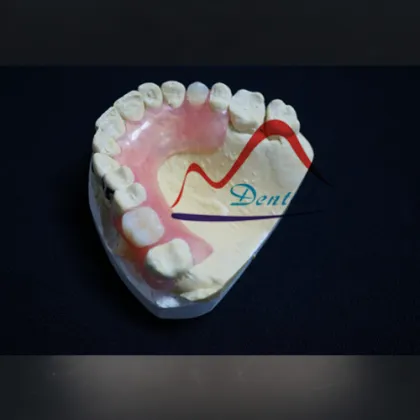 Mega Valplast Flexible Denture