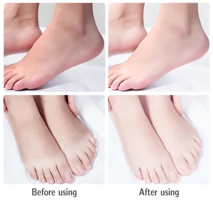 100ml Hand and feet creack urea foot cream