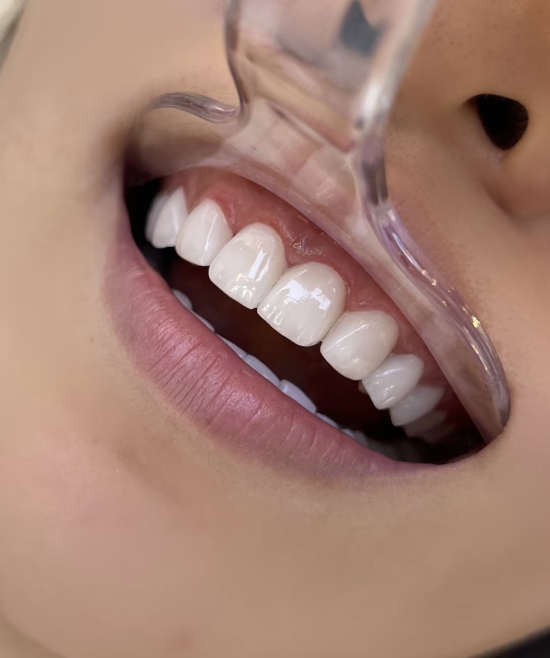 impiallacciature dentali dental veneers