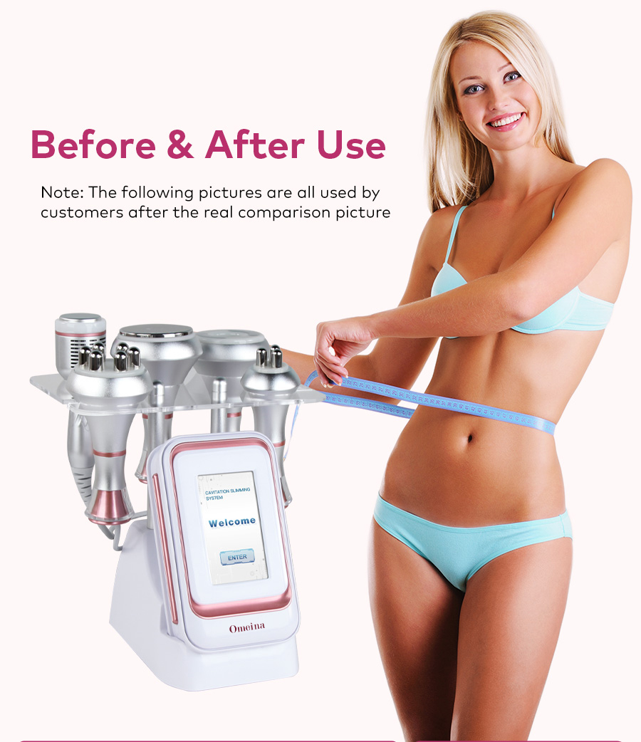 cavitation for cellulite