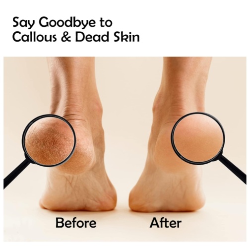 Sandpaper To Remove Calluses