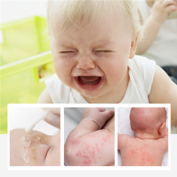 Eczema orgánico crema para bebés para bebés de hierbas a base de hierbas