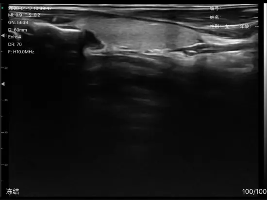 Super Width Linear Probe Type Wireless Mini Ultrasound