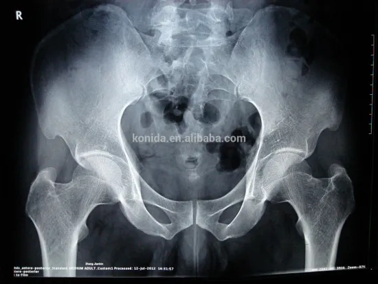 Agfa medical dry film for hospital machine 14*17inch KND-A film