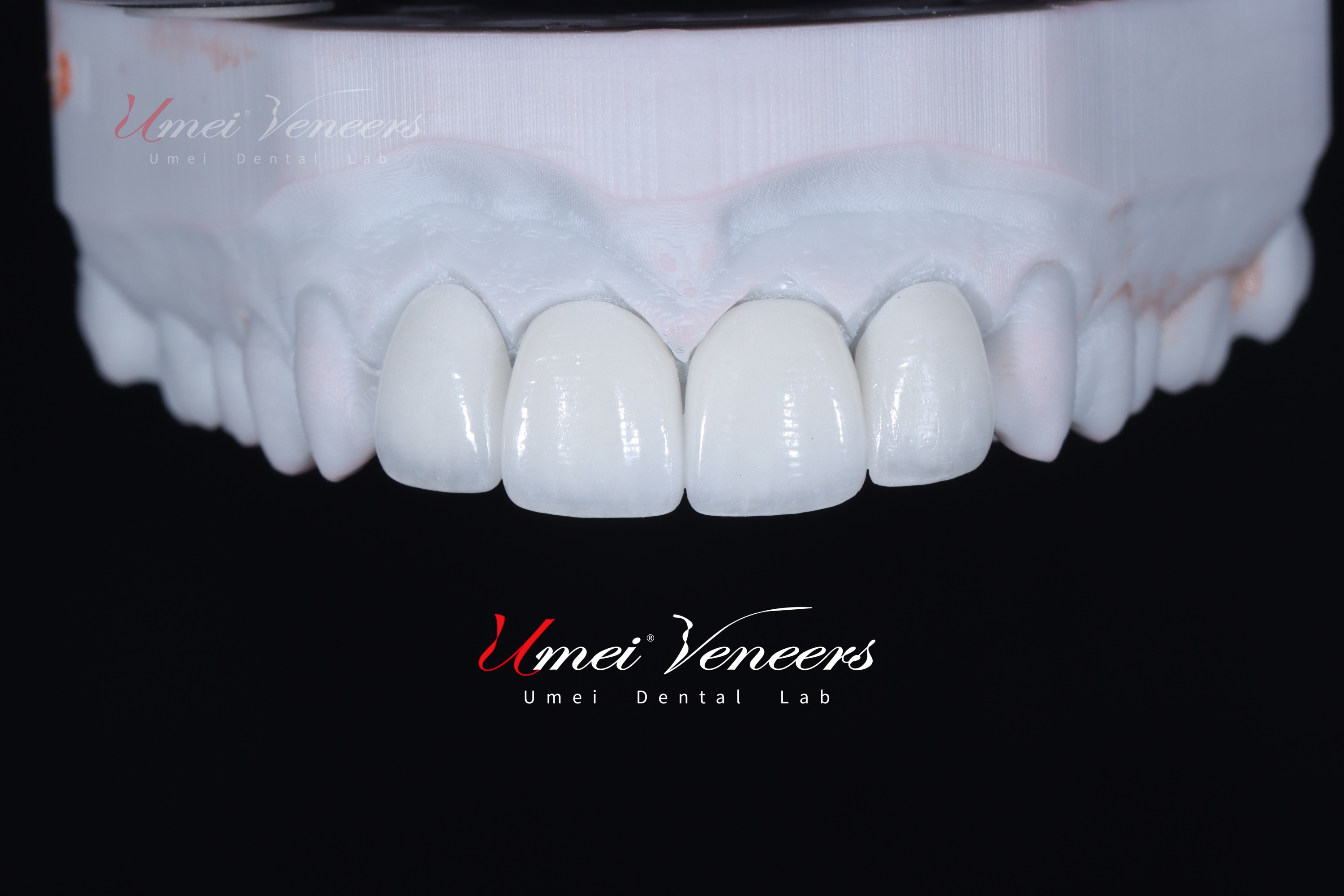 Zirconia Layered Veneers