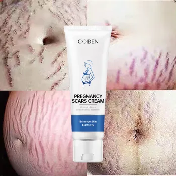 Stretch Mark and Scar Removal Cream for Women