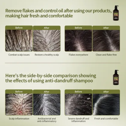Anti Dandruff Shampoo for Scalp Cleaning, Oil Control & Flaky Hair Removal